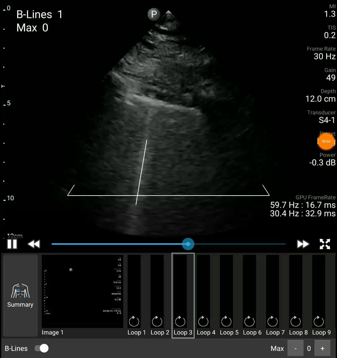 Philips FUS6884 Lumify S4-1 Portable Ultrasound Transducer