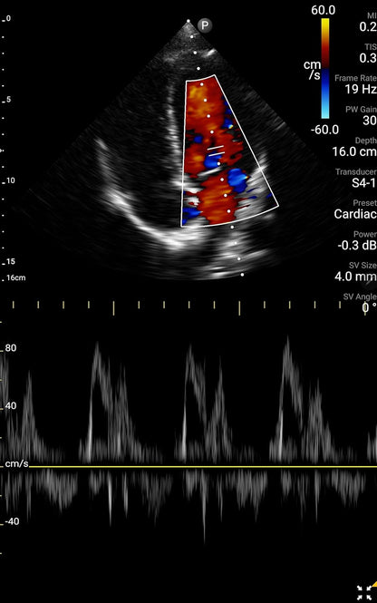Philips FUS6884 Lumify S4-1 Portable Ultrasound Transducer